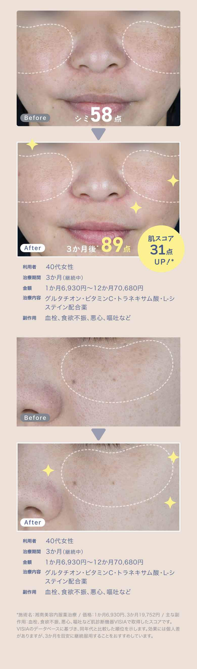 Before　シミ58点　After　3ヶ月後89点　肌スコア31点UP!　施術名：湘南美容内服薬治療 / 価格：1か月6,930円、3か月19,752円 / 主な副作用：血栓、食欲不振、悪心、嘔吐など肌診断機器VISIAで取得したスコアです。効果には個人差がありますが、3か月を目安に継続服用することをおすすめしています。